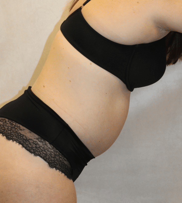 After Image: Case #5582 – Abdominoplasty – Tummy Tuck - right-front-oblique