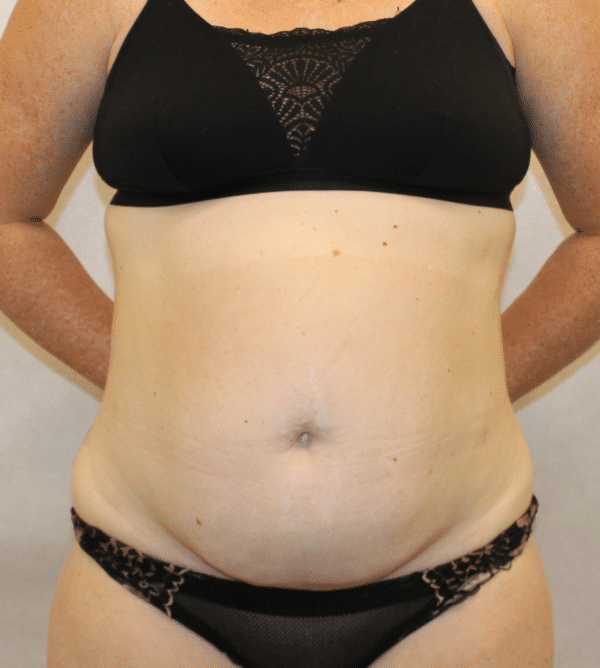 Before Image: Case #5582 – Abdominoplasty – Tummy Tuck - front