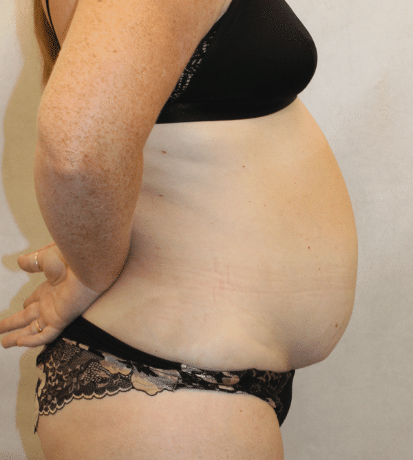 Before Image: Case #5582 – Abdominoplasty – Tummy Tuck - right-side