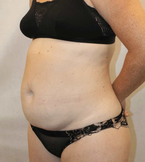 Before Image: Case #5582 – Abdominoplasty – Tummy Tuck - left-front-oblique