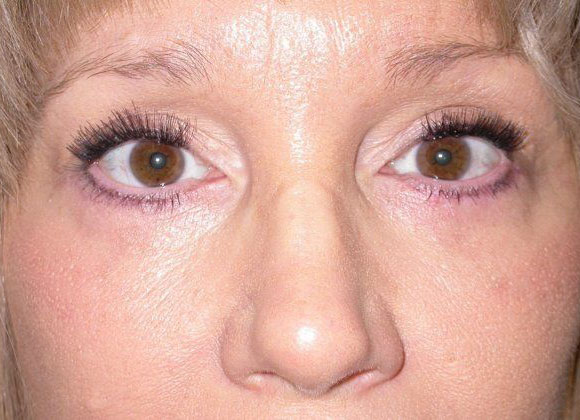 After Image: Case #562 – Eye Lift (Blepharoplasty) - front