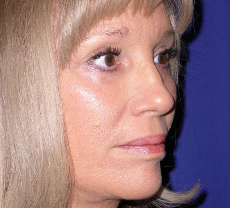 After Image: Case #562 – Eye Lift (Blepharoplasty) - right-front-oblique