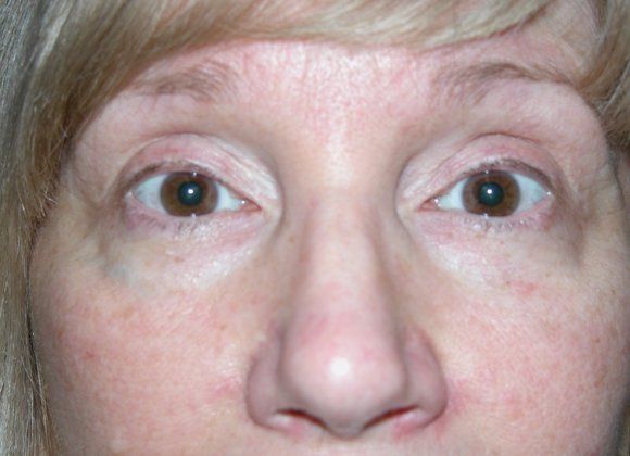 Before Image: Case #562 – Eye Lift (Blepharoplasty) - front