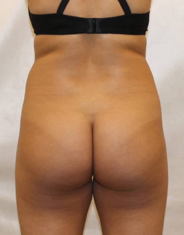 Before Image: Case #5722 – Brazilian Butt Lift - front