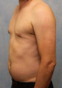 Case #582 – Male Breast Reduction