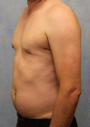 After Image: Case #582 – Male Breast Reduction - left-front-oblique