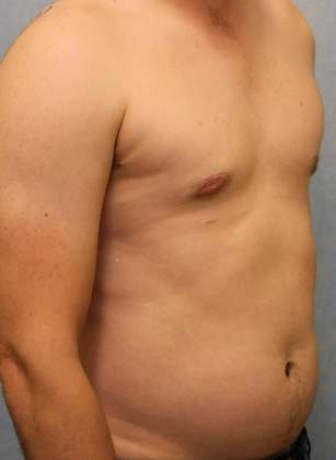 After Image: Case #582 – Male Breast Reduction - right-front-oblique
