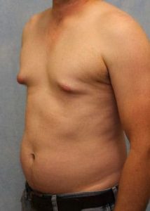 Case #582 – Male Breast Reduction