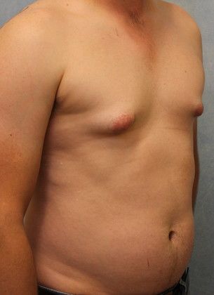 Before Image: Case #582 – Male Breast Reduction - right-front-oblique