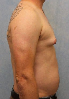 Before Image: Case #582 – Male Breast Reduction - right-side