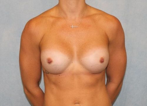 Case #59 – Breast Augmentation