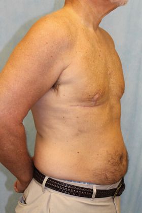 After Image: Case #590 – Male Breast Reduction