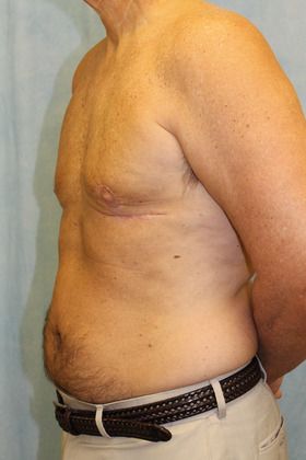 After Image: Case #590 – Male Breast Reduction - left-front-oblique