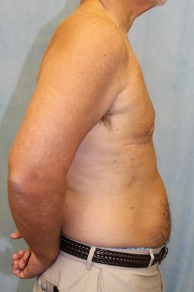 After Image: Case #590 – Male Breast Reduction - right-side