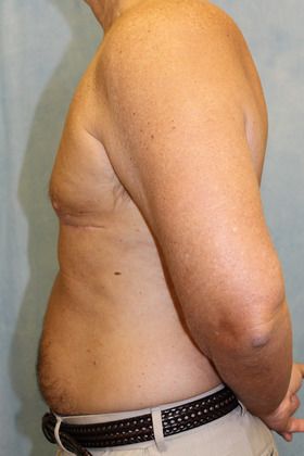 After Image: Case #590 – Male Breast Reduction - left-side