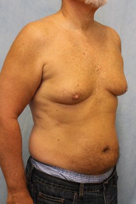 Before Image: Case #590 – Male Breast Reduction