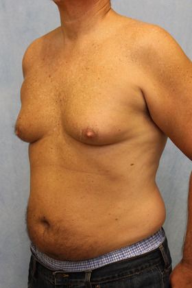 Before Image: Case #590 – Male Breast Reduction - left-front-oblique