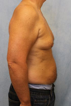 Before Image: Case #590 – Male Breast Reduction - right-side