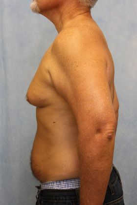 Before Image: Case #590 – Male Breast Reduction - left-side