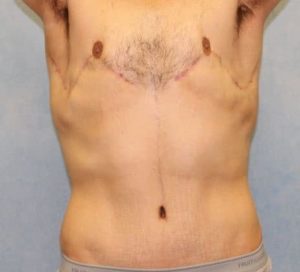 Case #600 – Male Breast Reduction