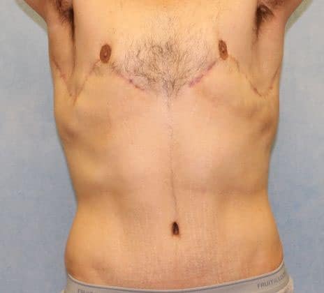 After Image: Case #600 – Male Breast Reduction