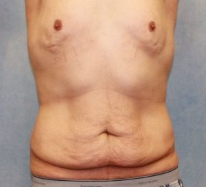 Case #600 – Male Breast Reduction