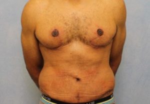 Case #612 – Male Breast Reduction