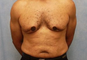 Case #612 – Male Breast Reduction
