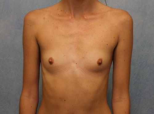 Case #69 – Breast Augmentation
