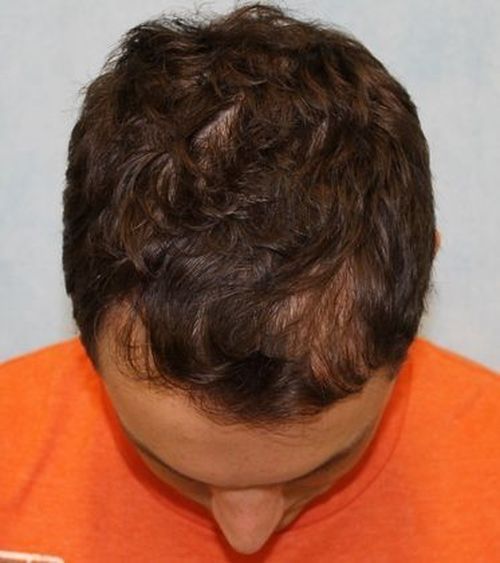 Case #698 – Hair Transplant