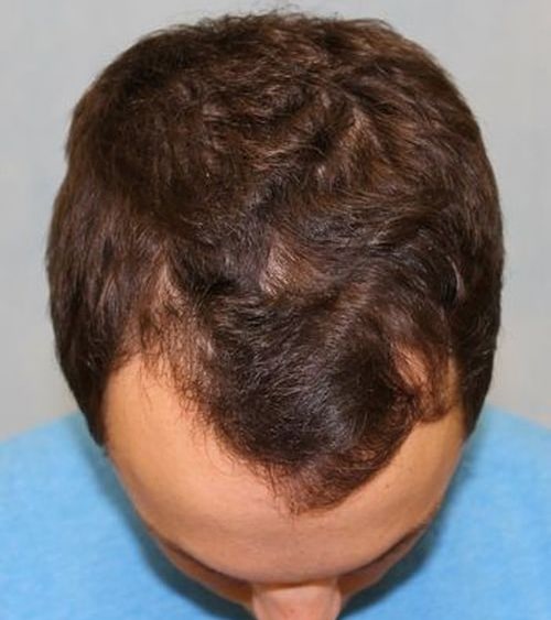 Case #698 – Hair Transplant