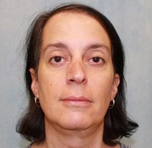 Case #702 – Hair Transplant