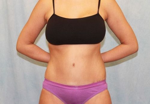 After Image: Case #740 – Abdominoplasty – Tummy Tuck - front