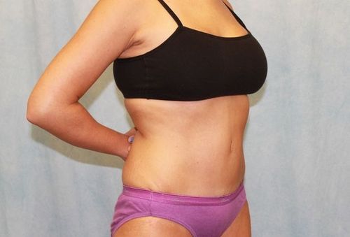 After Image: Case #740 – Abdominoplasty – Tummy Tuck - right-front-oblique