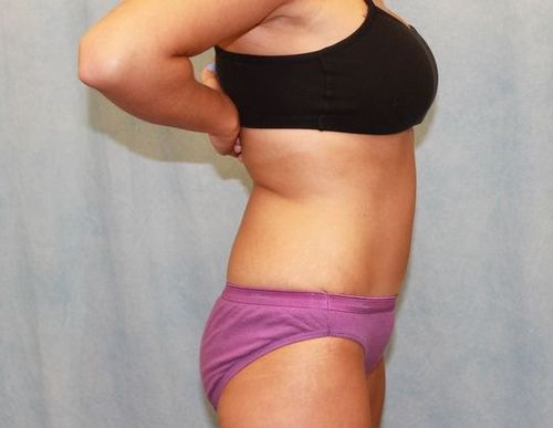 After Image: Case #740 – Abdominoplasty – Tummy Tuck - right-side