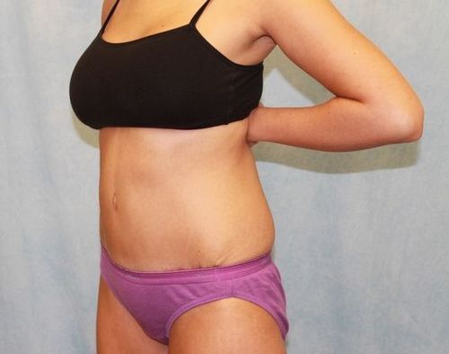 After Image: Case #740 – Abdominoplasty – Tummy Tuck - left-front-oblique