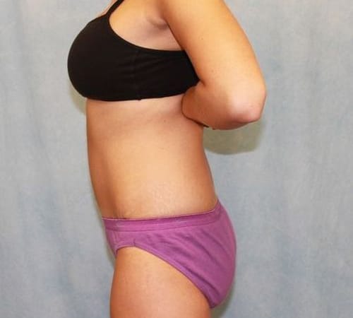 After Image: Case #740 – Abdominoplasty – Tummy Tuck - left-side