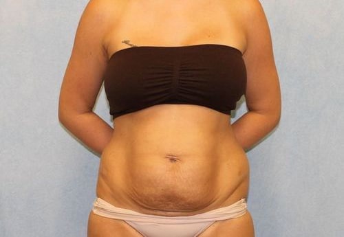 Before Image: Case #740 – Abdominoplasty – Tummy Tuck - front