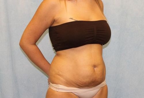 Before Image: Case #740 – Abdominoplasty – Tummy Tuck - right-front-oblique