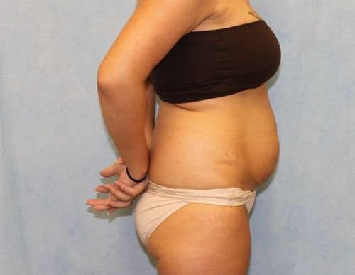 Before Image: Case #740 – Abdominoplasty – Tummy Tuck - right-side
