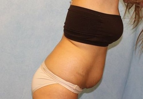 Before Image: Case #740 – Abdominoplasty – Tummy Tuck - right-front-oblique