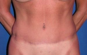 Case #754 – Abdominoplasty – Tummy Tuck