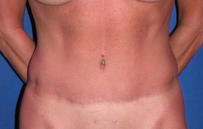 After Image: Case #754 – Abdominoplasty – Tummy Tuck - front