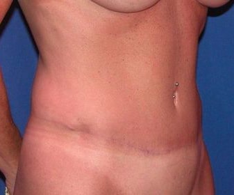 After Image: Case #754 – Abdominoplasty – Tummy Tuck - right-front-oblique