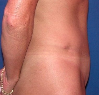 After Image: Case #754 – Abdominoplasty – Tummy Tuck - right-side