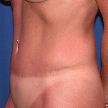 After Image: Case #754 – Abdominoplasty – Tummy Tuck - left-front-oblique