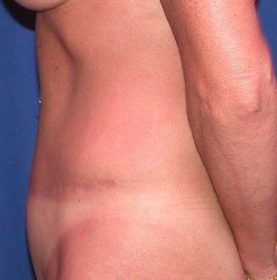 After Image: Case #754 – Abdominoplasty – Tummy Tuck - left-side