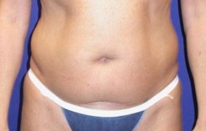 Case #754 – Abdominoplasty – Tummy Tuck