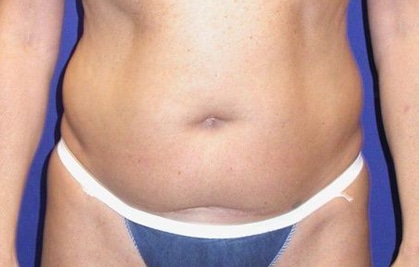 Before Image: Case #754 – Abdominoplasty – Tummy Tuck - front