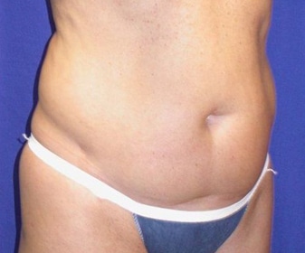 Before Image: Case #754 – Abdominoplasty – Tummy Tuck - right-front-oblique